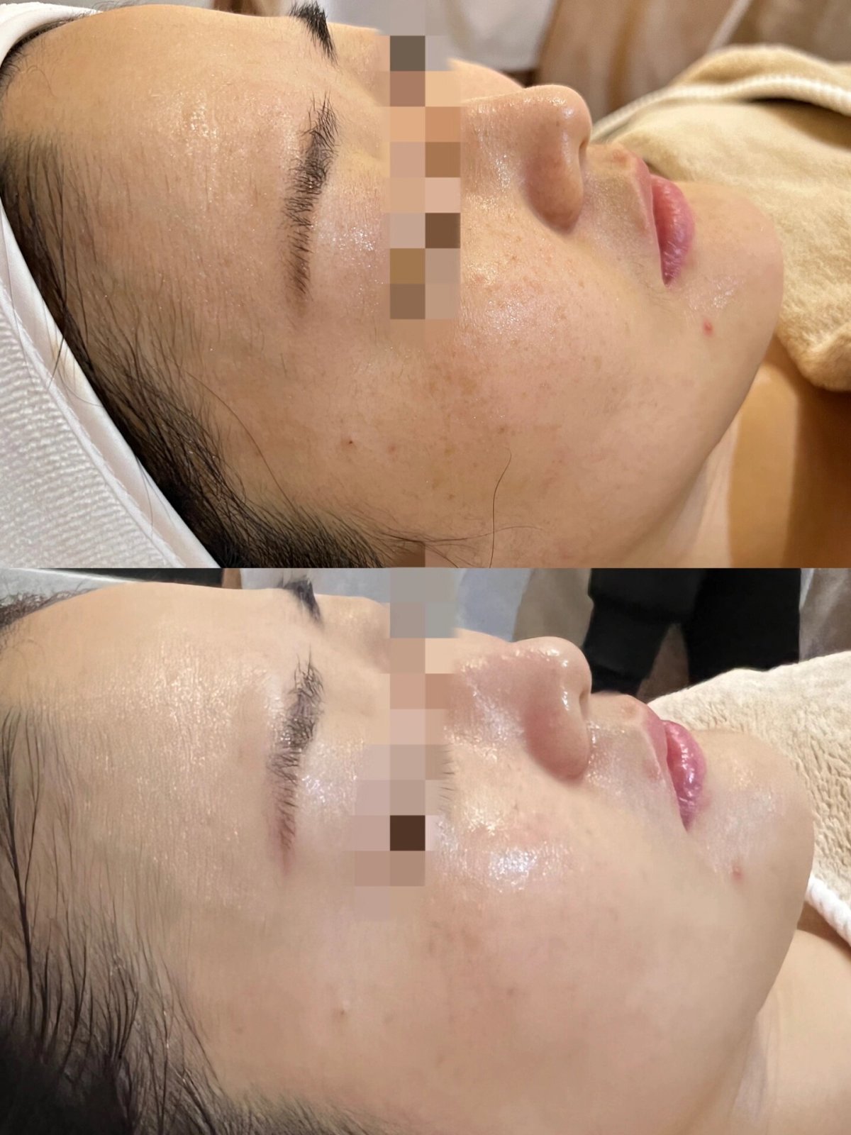 拒绝暗沉，迎接光彩 水光针轻松打造水润透