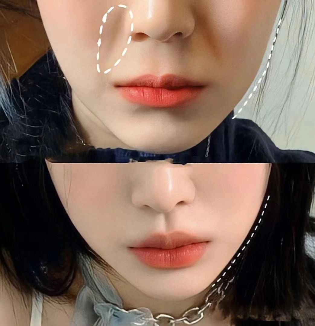 玻尿酸丰唇+法令纹 赶紧微调起来 嘴唇太
