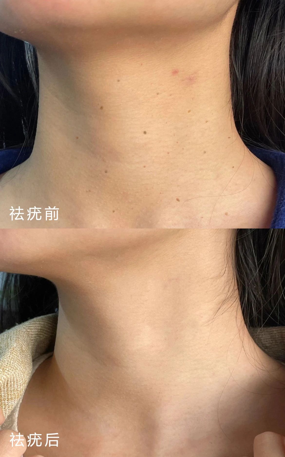 扁平疣.丝状疣的危害 一生二，二生三 三