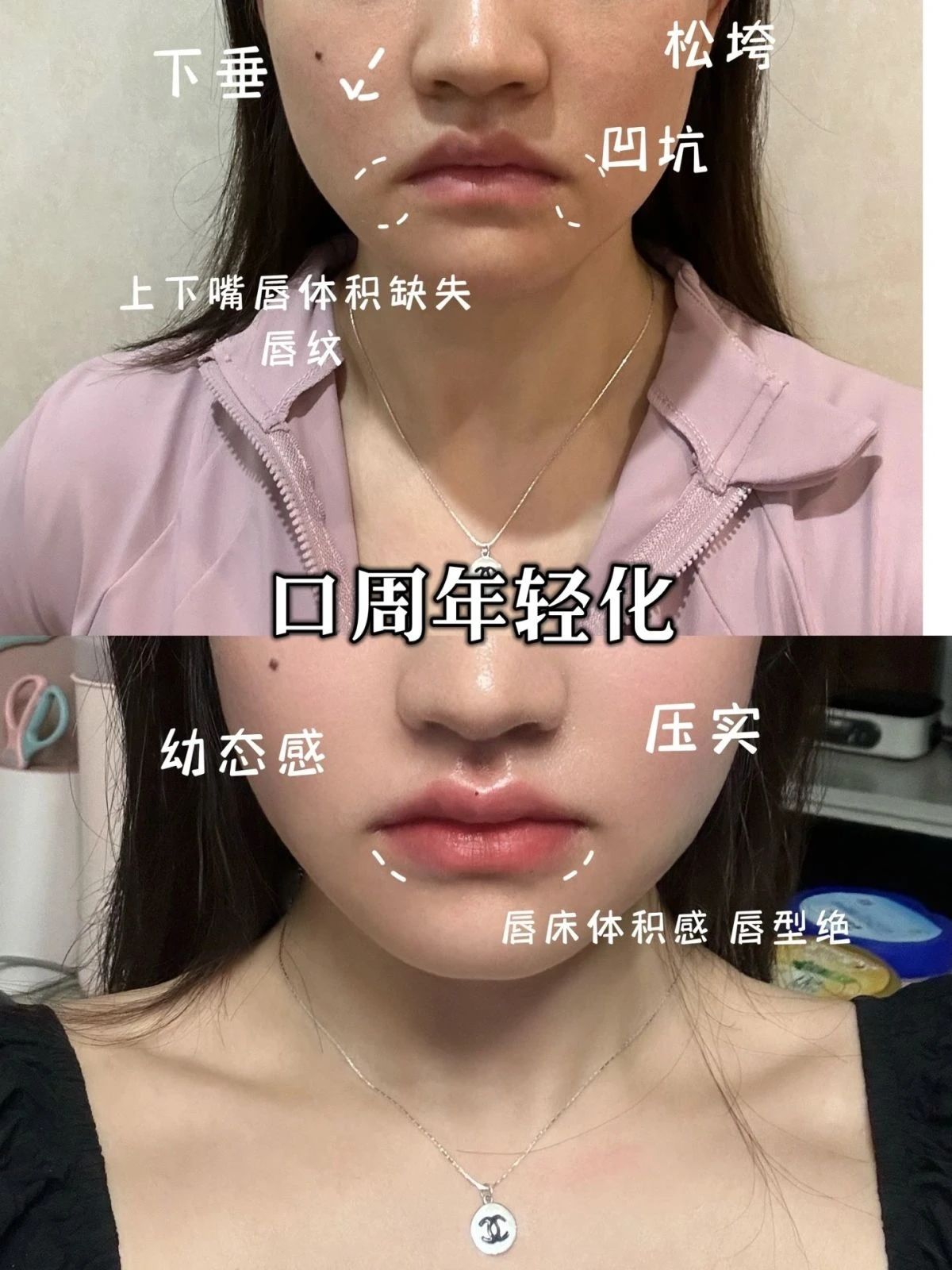 年轻感是什么标准⁉️ 嘴角肉 嘴角囊袋 