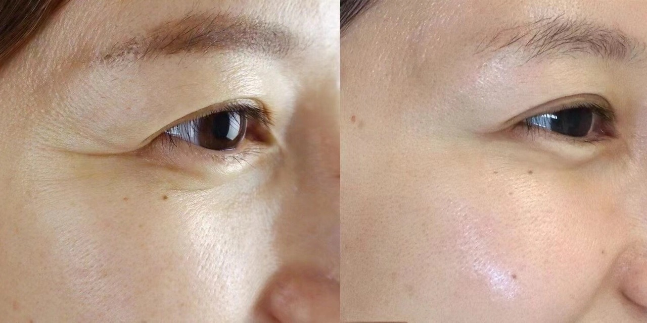 除皱💉 不要让眼周小细纹出卖了你的年龄…