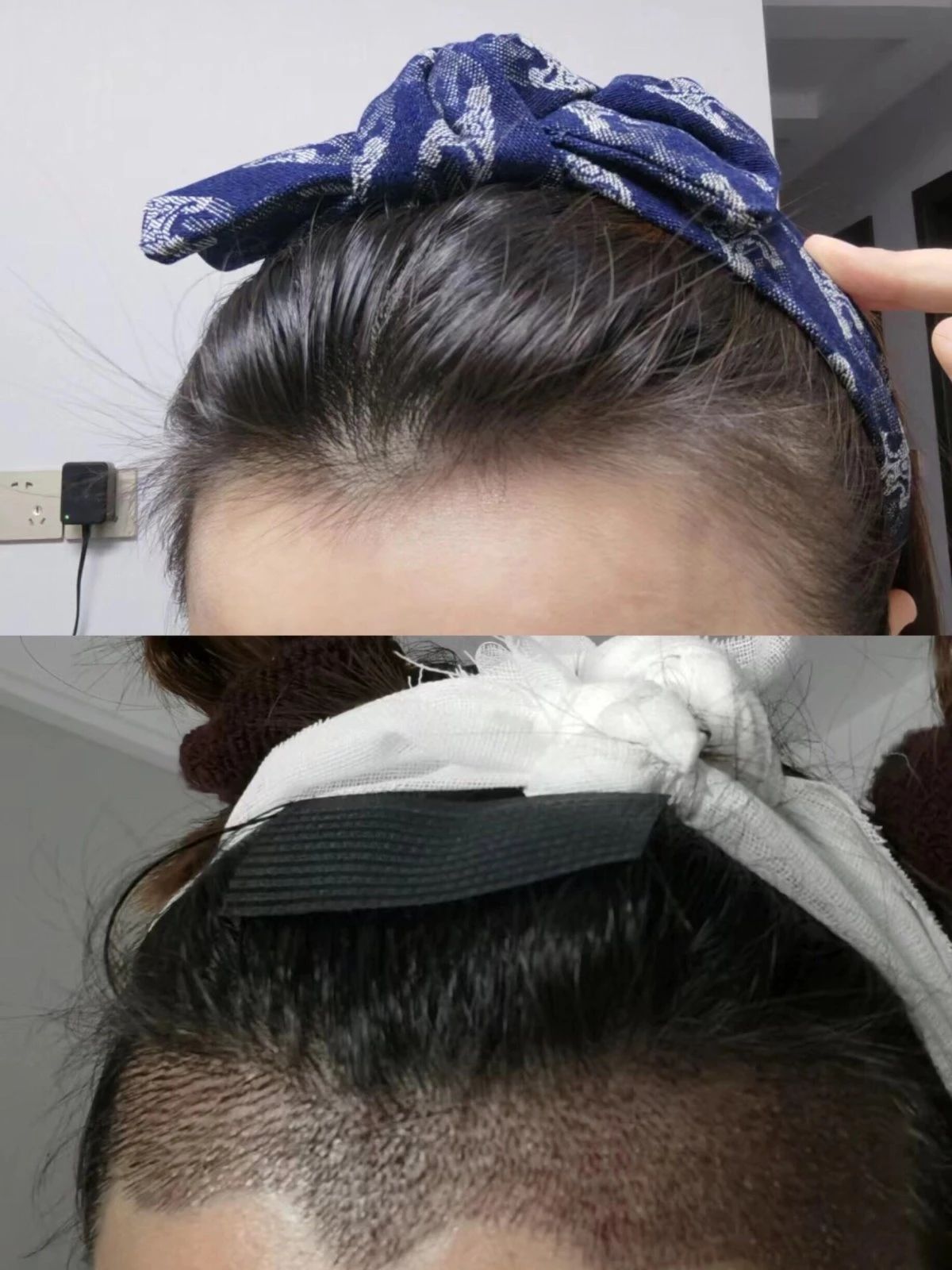 不剃发植发👇 完全避开术后尴尬期 不影响