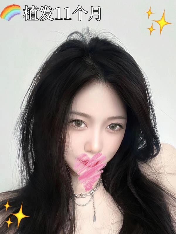 植发贵吗？ 消费那一刻觉得贵 放眼看后面 配图2