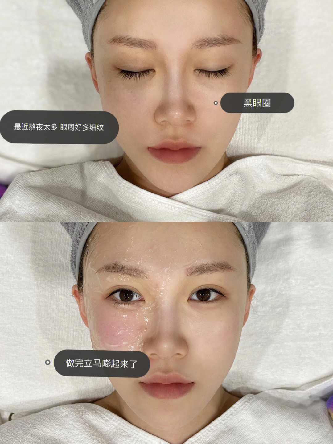 卡戴珊同款BTL胶原枪 20多岁的女生  配图3