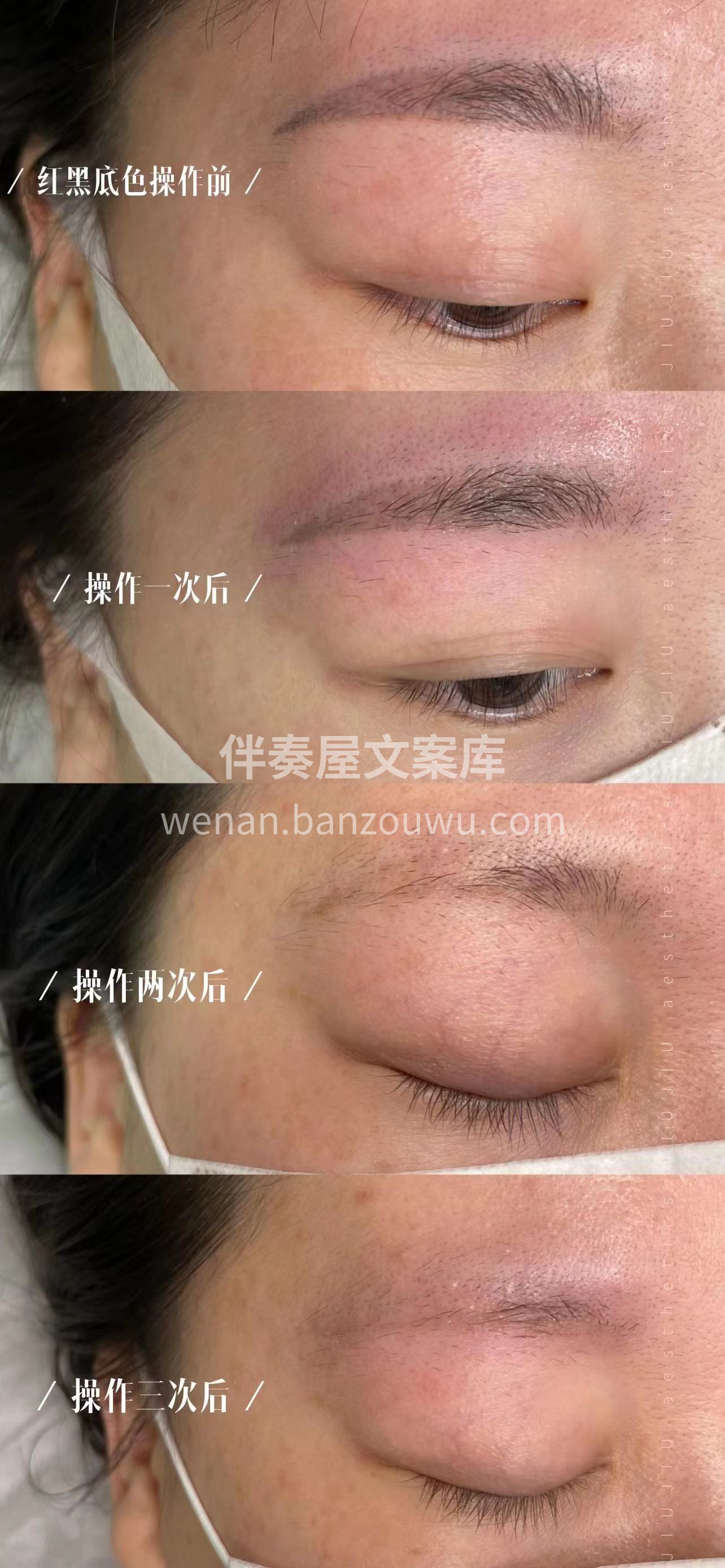 洗眉合集案例 配图5
