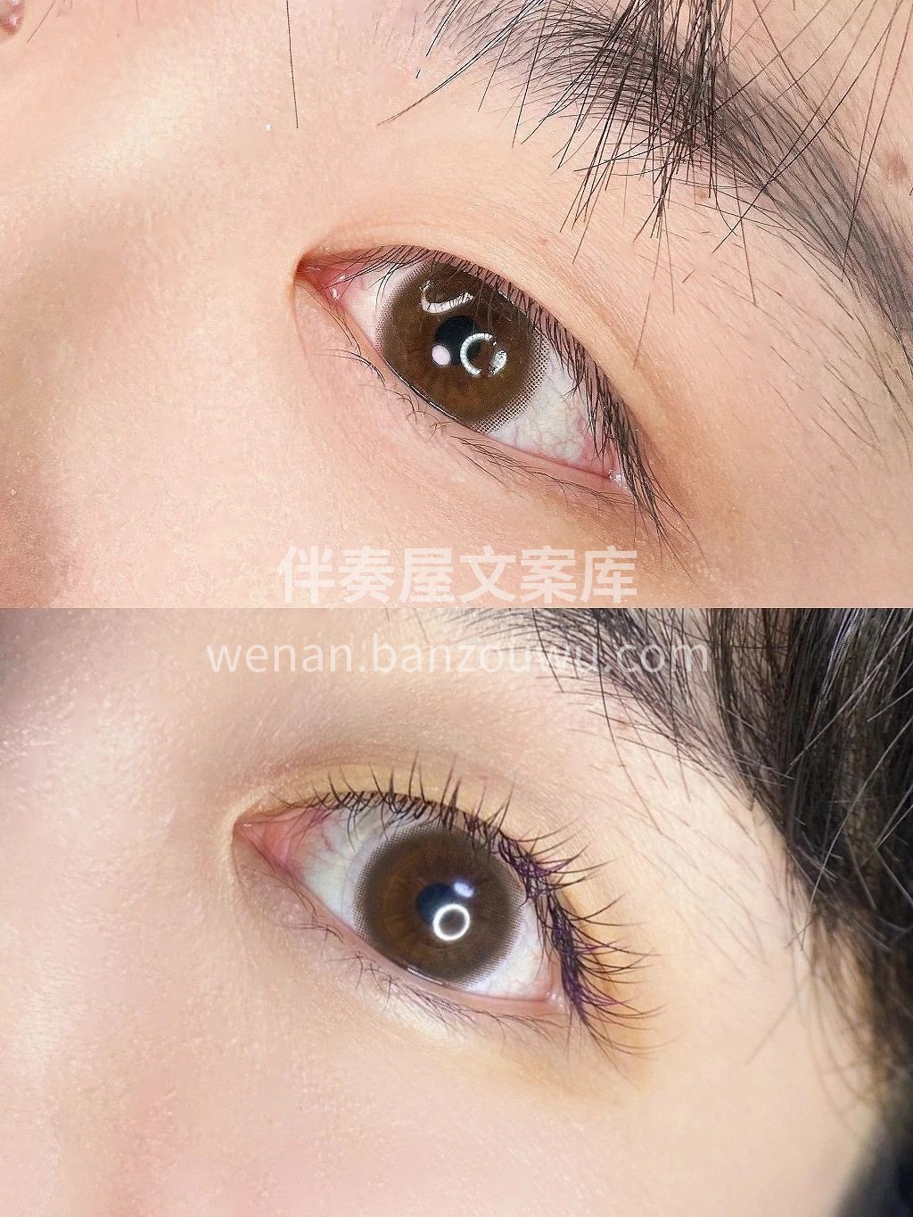 单眼皮、肿泡眼的妹妹，拉双眼皮怕痛 或者