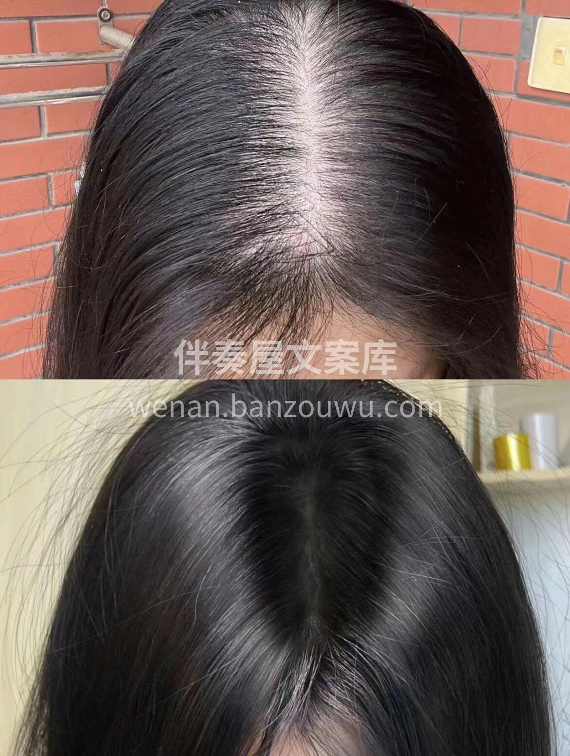 ✅头皮护理 缺少水分和营养容易造成 头皮