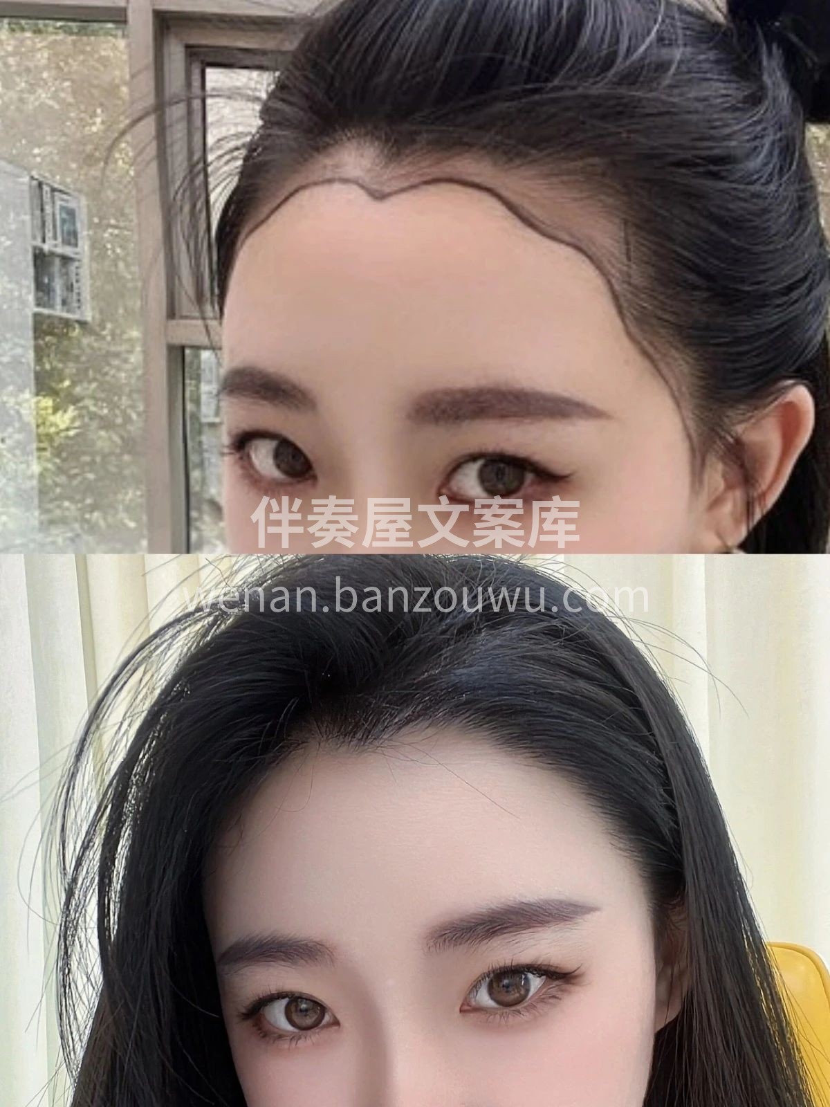 我觉得植发这件事很值 变年轻了 而且做各