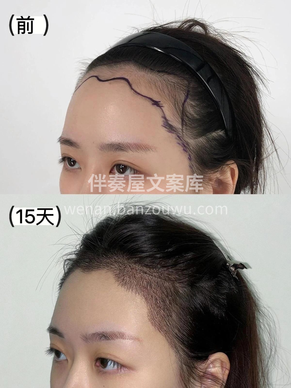 秃头大脑门 发际线后移都可以拯救 想做发