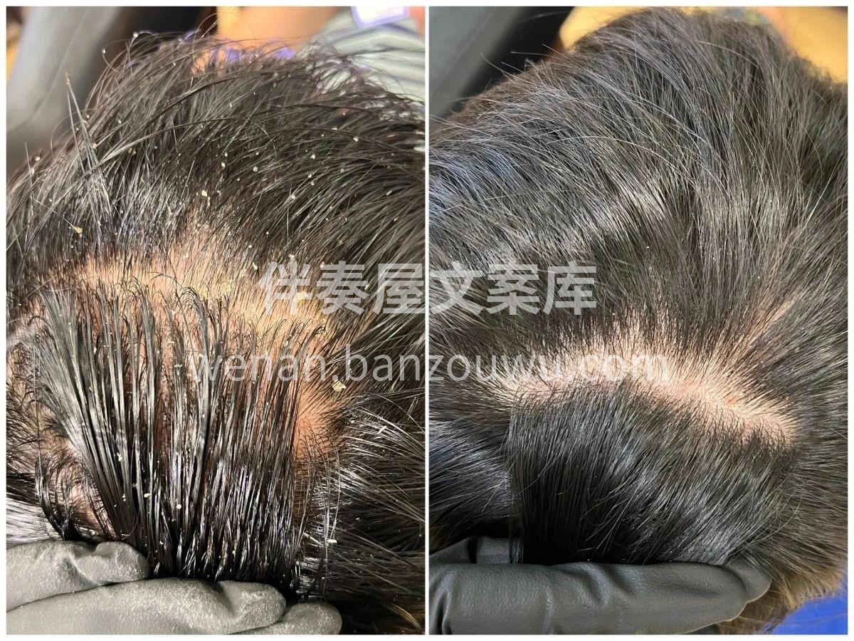 头皮清洁很重要 头皮和头发问题产生的原因