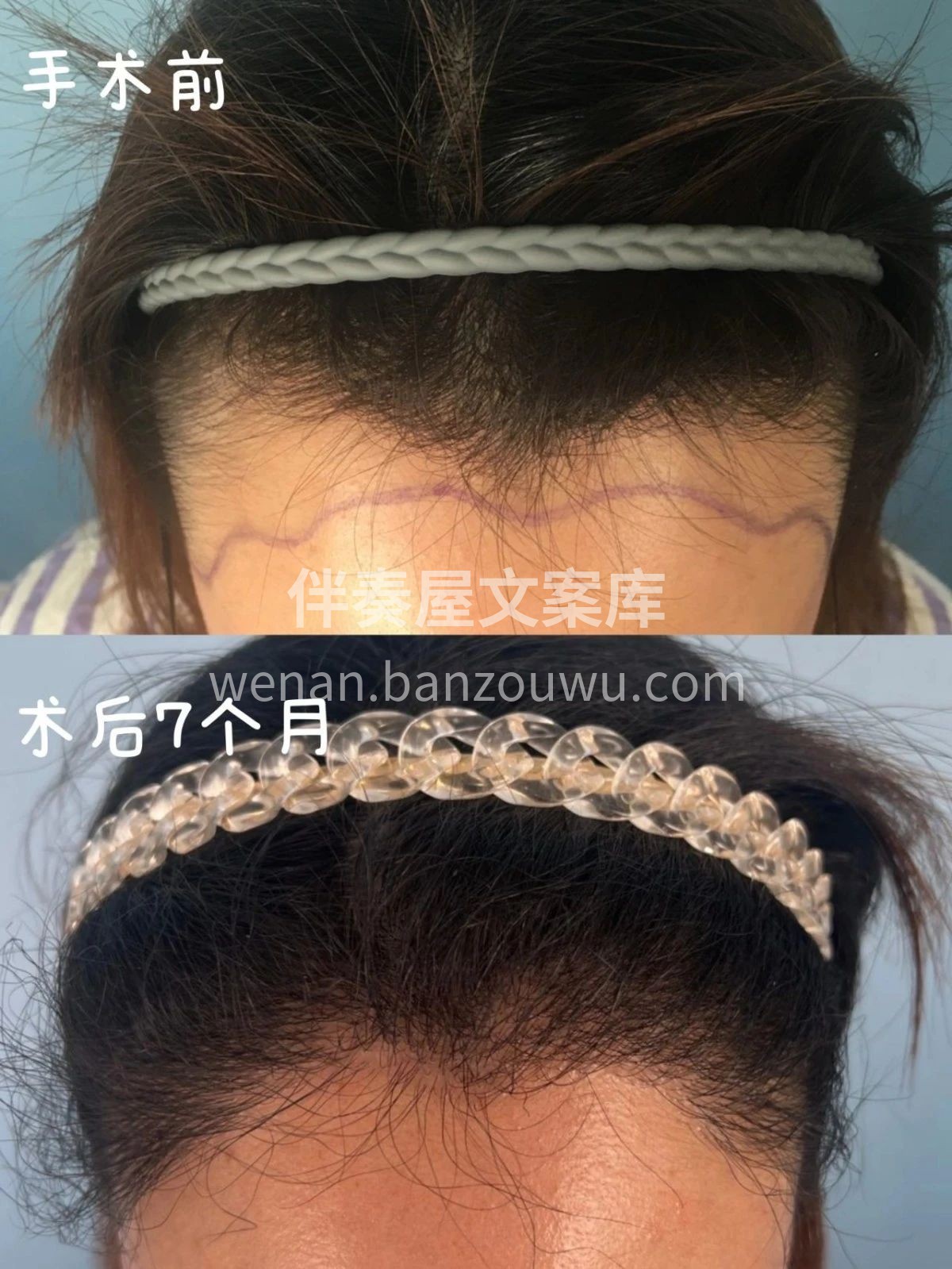 植完发，女生变女神 发际线考虑好审美 效