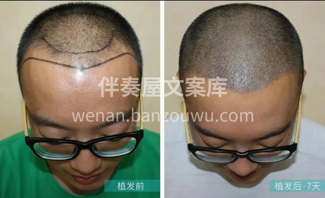 男士植发🎈 从头皮清晰可见到根根发丝重现