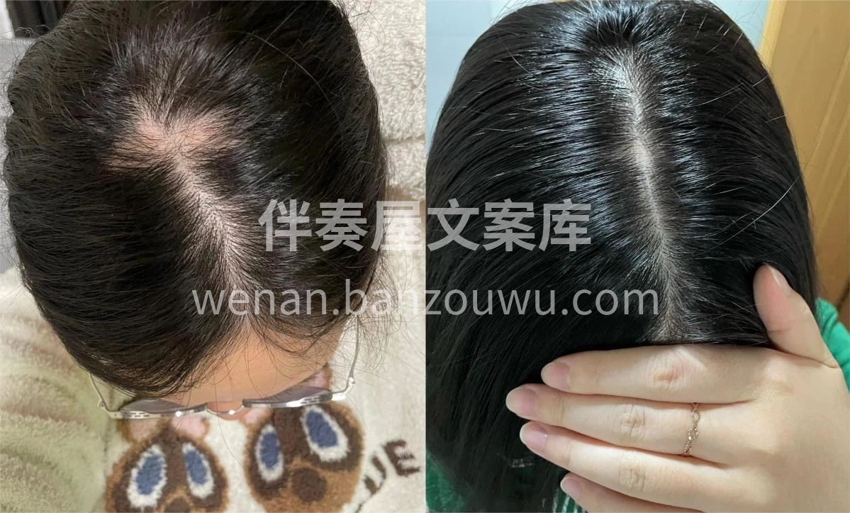 ⚠️脱发如果超过一年不养护 毛囊就会萎缩