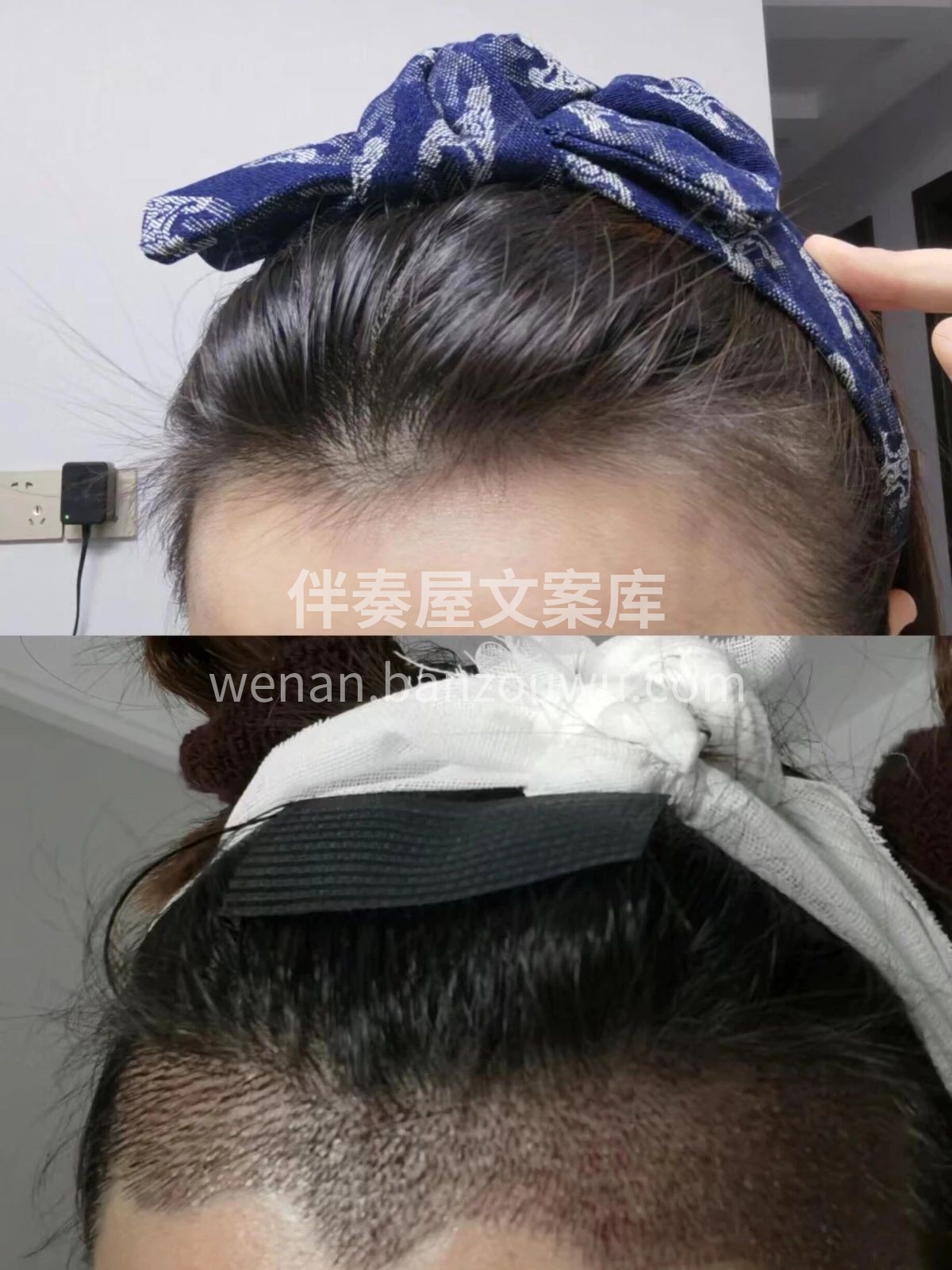 不剃发植发👇 完全避开术后尴尬期 不影响