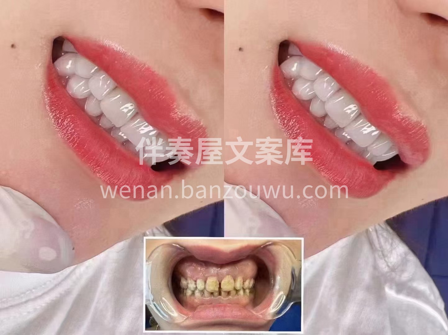 [咖啡][咖啡]很多‬人误以为美牙就是治