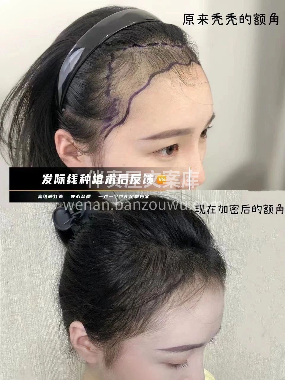 植发是永久的 填补空缺不留白 打造头包脸